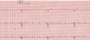 ECG in a dog with Third Degree Heart Block Notice the slow heart rate (number of large waves)