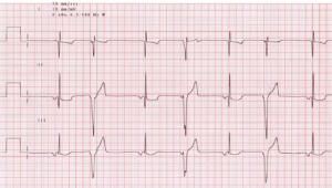 ECG