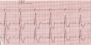 Paced-3rd-AV-block Same dog as above after pacemaker implantation Notice the increased heart rate (i.e. increased number of large waves)