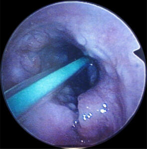 Excessive granulation tissue causing a partial obstruction of trachea