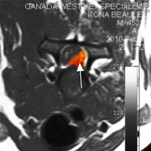 The arrow indicates disc material (coloured ORANGE here) that was compressing her spinal cord, resulting in her paralysis.