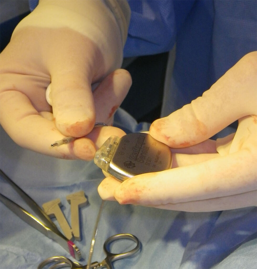 Pacemaker placement for treatment of advanced second degree heart block